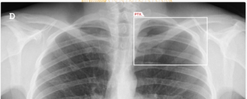 FDA Clears AZchest AI Software for New CXR Applications