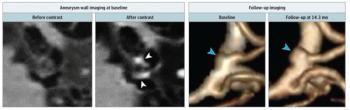 Study Shows Viability of Enhanced 3T MRI for Predicting Intracranial Aneurysm Instability