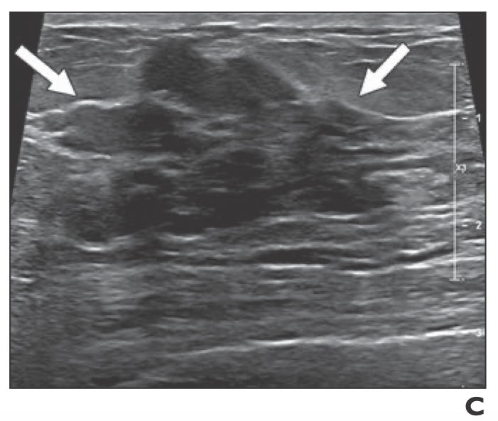 Breast Mri Identified Lesions During Neoadjuvant Therapy Are Largely Benign Breast Mri Identified Lesions During Neoadjuvant Therapy Are Largely Benign