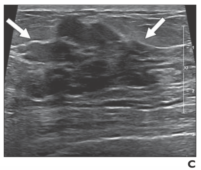 Breast Mri Identified Lesions During Neoadjuvant Therapy Are Largely Benign