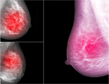 Diffusion-Weighted Imaging Helps Detect Breast Cancer in Dense Breasts 