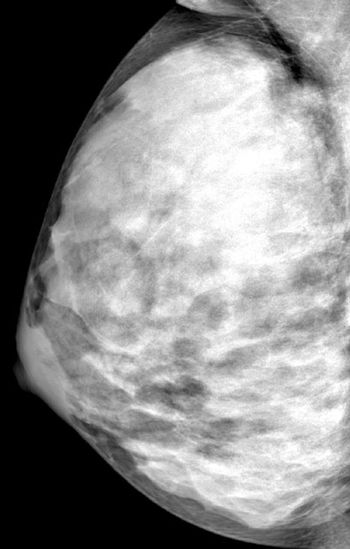 dense breast tissue
