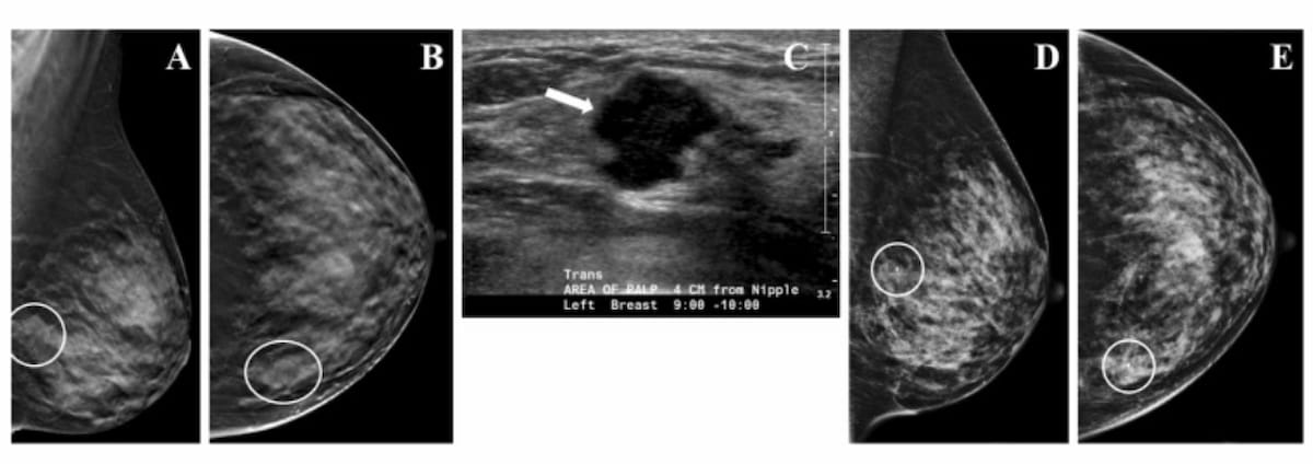 Mammography Study Reveals Limitations with DBT in Women with Extremely Dense Breasts