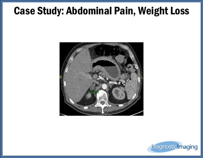 Abdominal Pain, Weight Loss