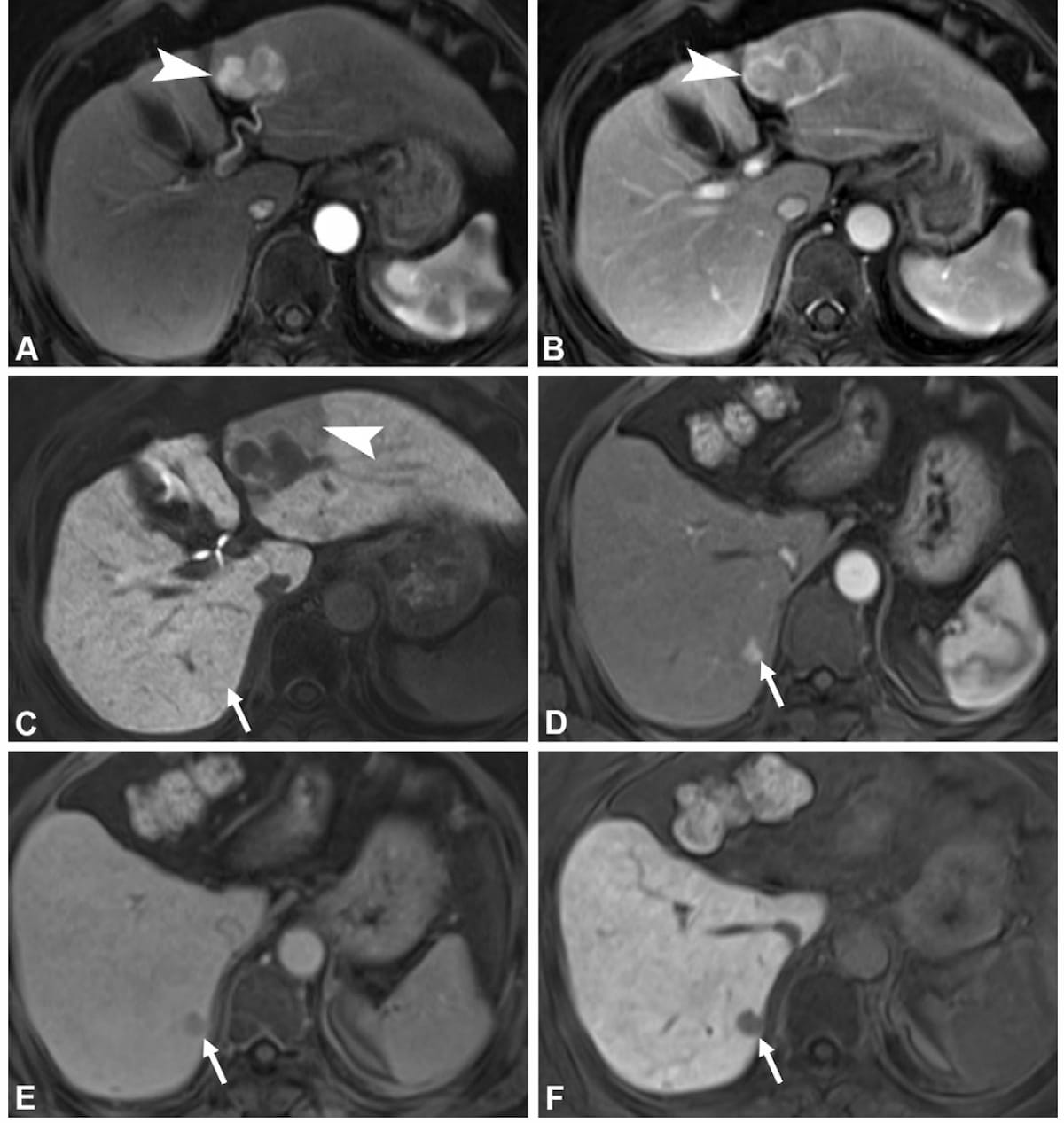 Emerging MRI Scoring System May Bolster Risk Stratification for Early Recurrence of HCC