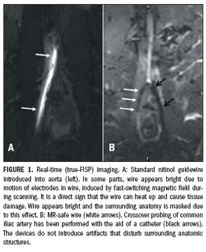 MR guidance prepares to enter endovascular realm