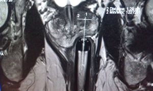 MRI Guided Focal Laser Ablation for Prostate Cancer