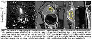 Focused ultrasound ablation offer prostate cancer option