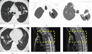 Computed Tomography Study Assesses Model for Predicting Recurrence of Non-Small Cell Lung Cancer