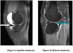 Bucket Handle Tear of Lateral Meniscus