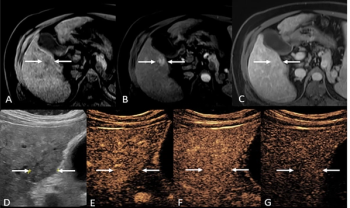 Study: Contrast-Enhanced Ultrasound May Improve LI-RADS Assessment of High-Risk Indeterminate Liver Lesions