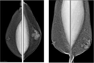Image IQ: 50-year-old Male, Palpable Lump on Left Breast