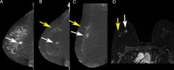 New Study on Contrast-Enhanced Mammography Reveals Malignancy Link with Combination of Mass Enhancement and Low-Energy Findings