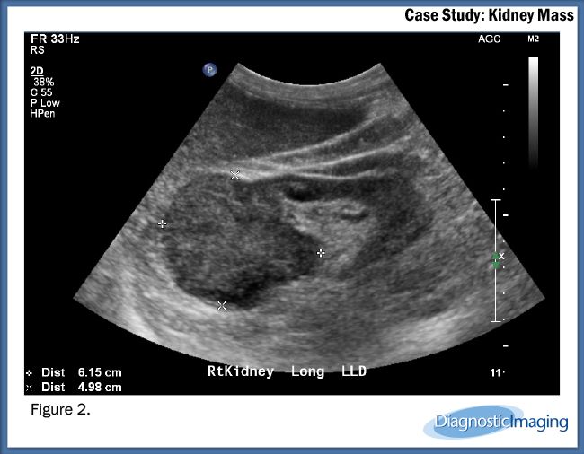 Kidney Mass kidney-mass