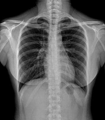 FDA Issues Breakthrough Device Designation for AI CXR Triage Software for Pneumomediastinum and Lung Collapse