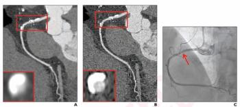 Study Shows Enhanced Diagnosis of Coronary Artery Stenosis with Photon-Counting CTA