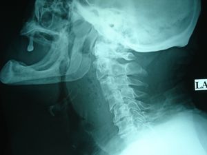Cervical Prevertebral Abscess