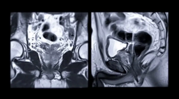 Prostate MRI Study Examines Key Predictors of False-Negative and False-Positive Results 