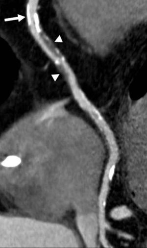 Snore much? You’re at risk for aggressive heart disease, study finds