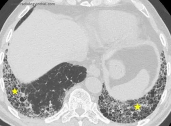 FDA Clears CT-Based AI Software for Enhanced Detection of Usual Interstitial Pneumonia