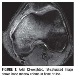 Bone marrow edema aids diagnosis and prognosis