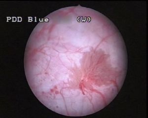 Cysview-Assisted Transurethral Resection of Bladder (TURB)