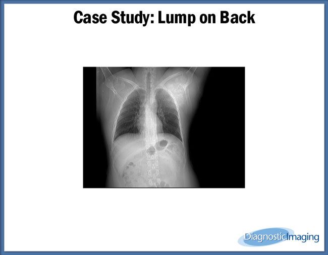 lump-on-back-diagnostic-imaging