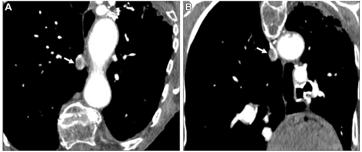 Study Shows Mixed Results with AI Software for PE Detection on CTPA Scans