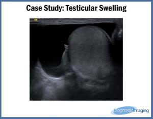 Testicular Swelling