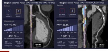 CT-Based Staging System for Coronary Artery Disease Gets FDA’s Breakthrough Device Designation
