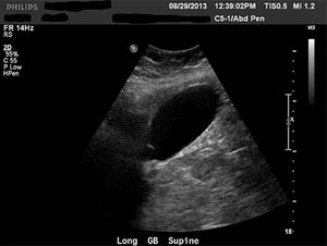 Renal Cell Carcinoma