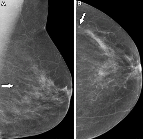 What a New Study Reveals About Radiographers and Mammography Assessment