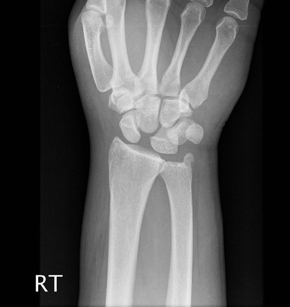 Lunate Dislocation