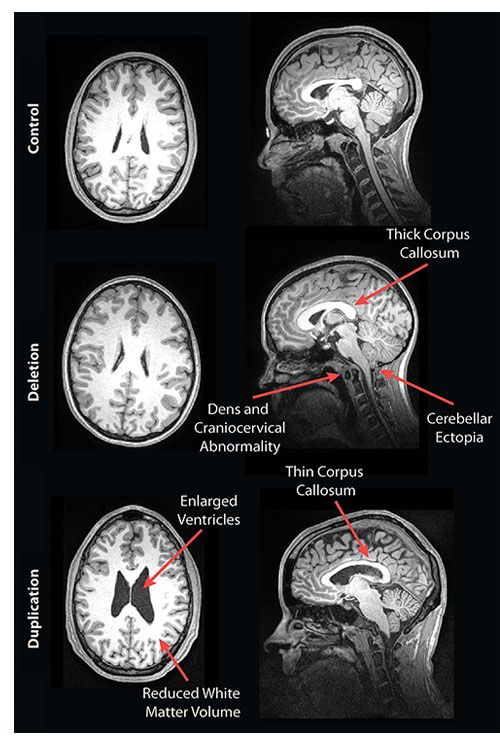 Brain Mri Of People With Genetic Autism