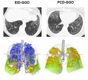 Study Looks at Combining PCCT and Lung Texture Analysis for Evaluating ILD in Patients with Systemic Sclerosis