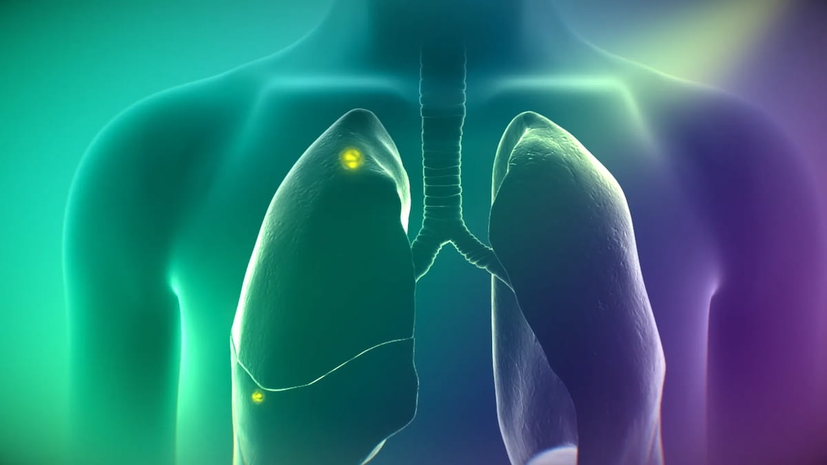 CMS Approves NTAP Reimbursement for Molecular Imaging Agent Cytalux