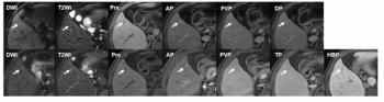 Can Gadoxetic Acid-Enhanced MRI Improve Detection of Sub-centimeter HCC Recurrence?