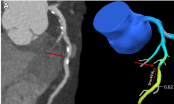 Study: CCTA-Derived Fraction Flow Reserve Can Predict MI and Mortality Risks in Patients with Stable Angina