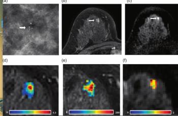 Assessing the Utility of mpMRI for Enhancing Diagnostic Clarity with Suspicious Calcifications from Mammography Exams