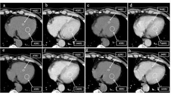 Should Chest CT be Routine for Prostate Cancer Patients on Androgen Deprivation Therapy?
