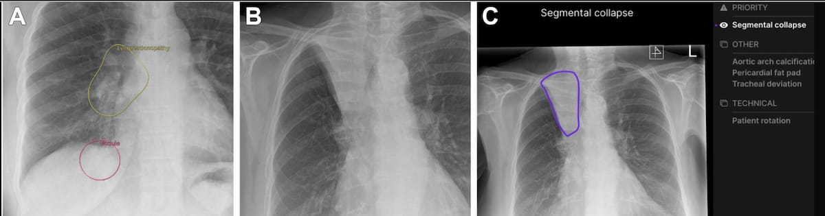 Comparative Radiology Study Reveals ‘Significant Variability’ with AI CXR Software for Lung Cancer Detection