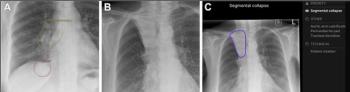 Comparative Radiology Study Reveals ‘Significant Variability’ with AI CXR Software for Lung Cancer Detection
