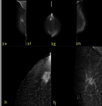 Contrast-Enhanced Mammography and High-Concentration ICM Dosing: What a New Study Reveals