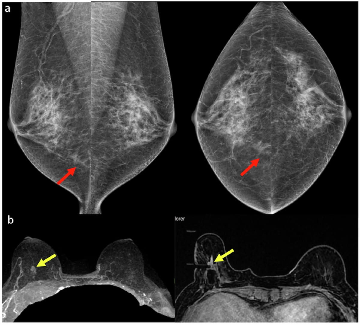 Seven Takeaways from New Review of Common Mammography Misses 