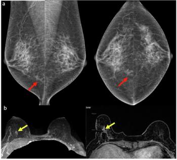 Seven Takeaways from New Review of Common Mammography Misses 
