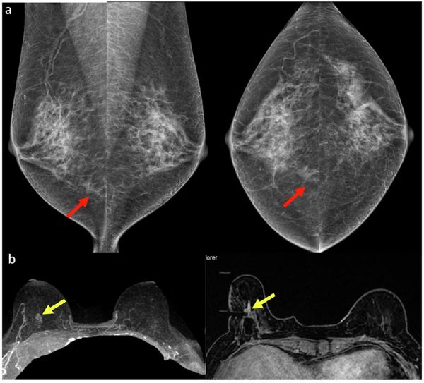 Seven Takeaways from New Review of Common Mammography Misses 
