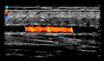 Fujifilm Sonosite Unveils Ultra-High Frequency Transducer for Point-of-Care Ultrasound