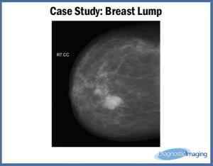Breast Lump