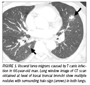 Imaging provides answersin parasitic infections