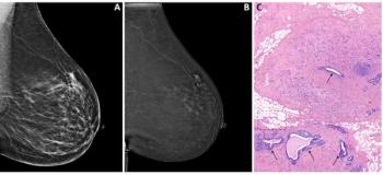 Can Contrast-Enhanced Mammography Offer a Viable Option for Pre-Op Assessment of Pathologic Nipple Involvement?